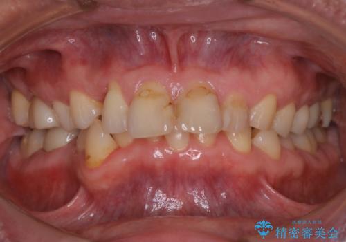 被せ物治療が終了したため全体的にクリーニングをの症例 治療前