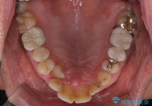 被せ物治療が終了したため全体的にクリーニングをの治療前