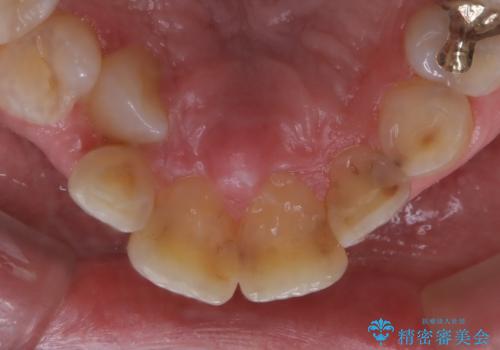 被せ物治療が終了したため全体的にクリーニングをの治療前