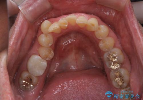 被せ物治療が終了したため全体的にクリーニングをの治療前