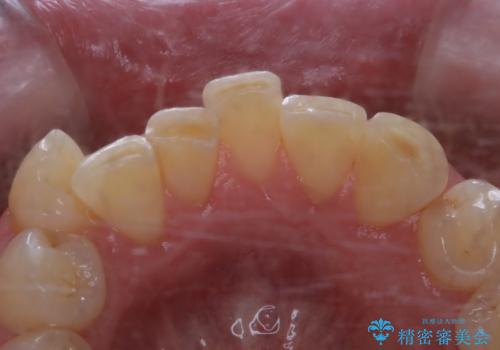被せ物治療が終了したため全体的にクリーニングをの治療前