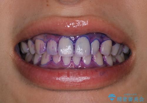 ホワイトニング前にクリーニングの症例 治療前