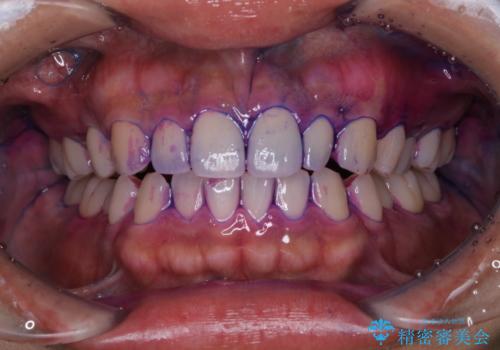 ホワイトニング前にクリーニングの治療前