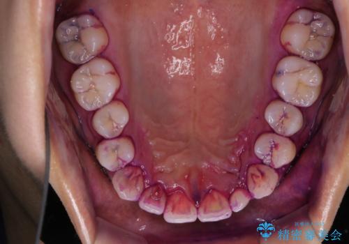 ホワイトニング前にクリーニングの治療前