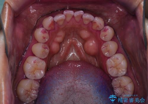 ホワイトニング前にクリーニングの治療前