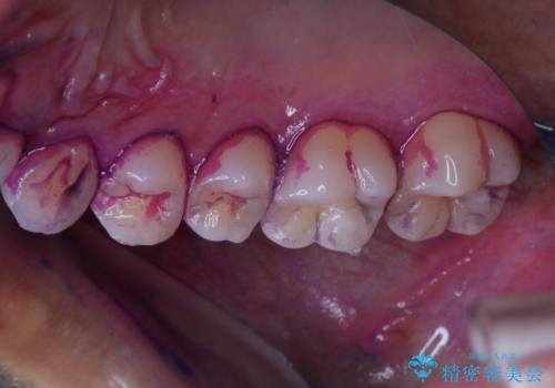 ホワイトニング前にクリーニングの治療前