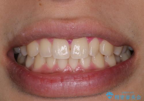 ホワイトニング前にクリーニングの症例 治療後