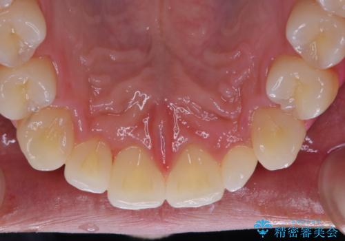ホワイトニング前にクリーニングの治療後