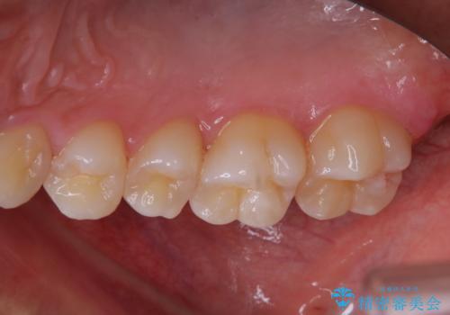 ホワイトニング前にクリーニングの治療後