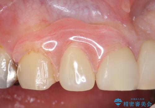 ノンクラスプデンチャー 抜歯になった歯の補綴の治療後