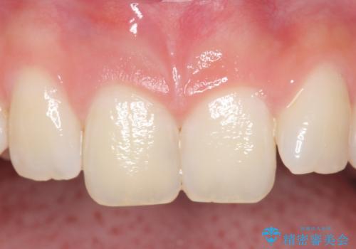 オールセラミッククラウン 痛みの引かない歯の治療の症例 治療前