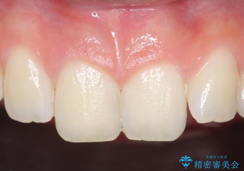 オールセラミッククラウン 痛みの引かない歯の治療の治療前