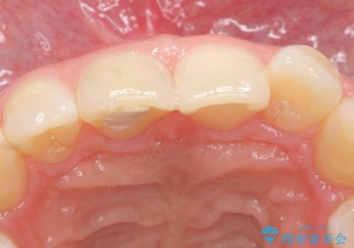 オールセラミッククラウン 痛みの引かない歯の治療の治療前
