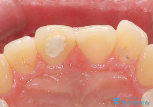 オールセラミッククラウン 痛みの引かない歯の治療の治療前