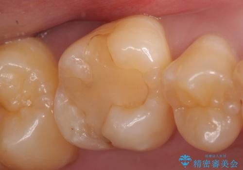PGA(ゴールド)インレー 欠けた古い樹脂のやり替えの治療前
