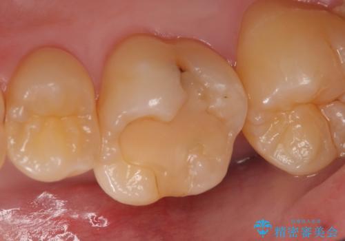 PGA(ゴールド)インレー 欠けた古い樹脂のやり替え