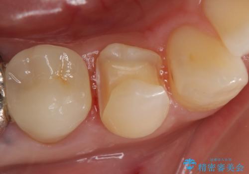 PGA(ゴールド)インレー 甘いものがしみる歯の治療の治療中