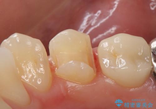 PGA(ゴールド)インレー 甘いものがしみる歯の治療の治療中