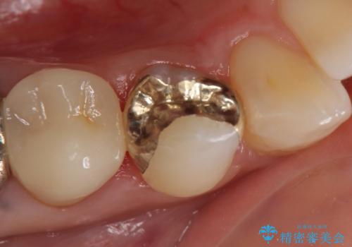 PGA(ゴールド)インレー 甘いものがしみる歯の治療の治療後
