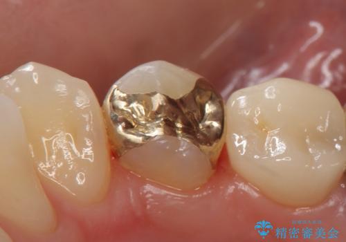 PGA(ゴールド)インレー　甘いものがしみる歯の治療の治療後