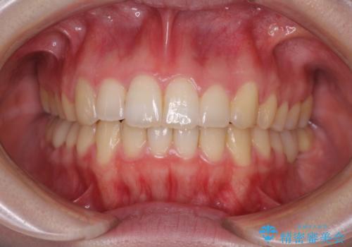 インプラント治療とインビザライン矯正治療 総合歯科治療の症例 治療後