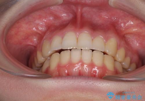 インプラント治療とインビザライン矯正治療 総合歯科治療の治療後