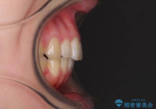 インプラント治療とインビザライン矯正治療 総合歯科治療の治療後