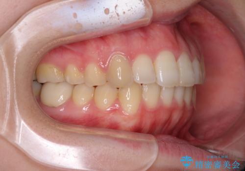 インプラント治療とインビザライン矯正治療 総合歯科治療の治療後