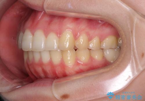 インプラント治療とインビザライン矯正治療 総合歯科治療の治療後