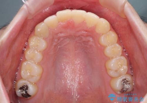 インプラント治療とインビザライン矯正治療 総合歯科治療の治療後