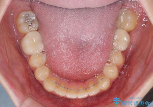 インプラント治療とインビザライン矯正治療 総合歯科治療の治療後