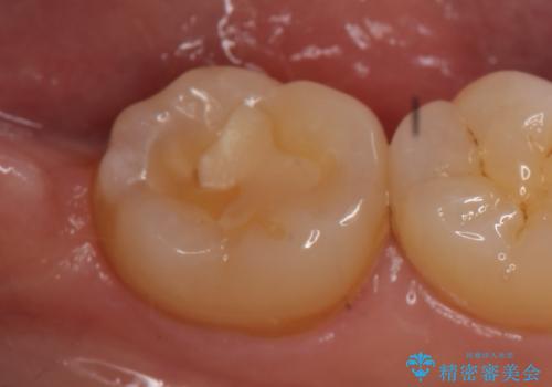PGA(ゴールド)インレー 冷たいものがしみる歯の治療の治療前