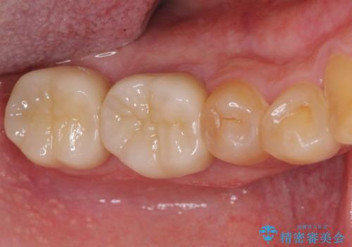 骨の中にまで及んだ深い虫歯 歯周外科処置を用いた補綴治療の治療後