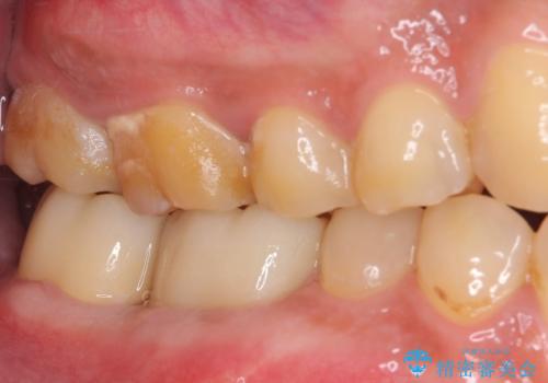 骨の中にまで及んだ深い虫歯 歯周外科処置を用いた補綴治療の治療後
