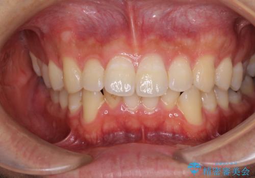 口が少し閉じにくい　インビザラインによる非抜歯矯正の治療前