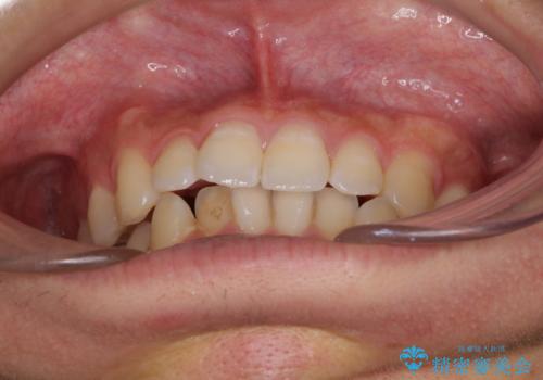 口が少し閉じにくい インビザラインによる非抜歯矯正の治療前