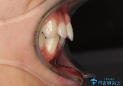 口が少し閉じにくい インビザラインによる非抜歯矯正の治療前