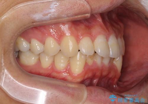 口が少し閉じにくい インビザラインによる非抜歯矯正の治療前