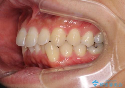 口が少し閉じにくい インビザラインによる非抜歯矯正の治療前