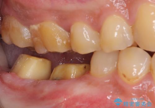 骨の中にまで及んだ深い虫歯 歯周外科処置を用いた補綴治療の治療中