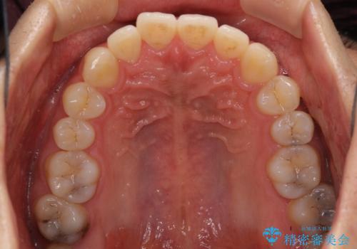 口が少し閉じにくい インビザラインによる非抜歯矯正の治療前