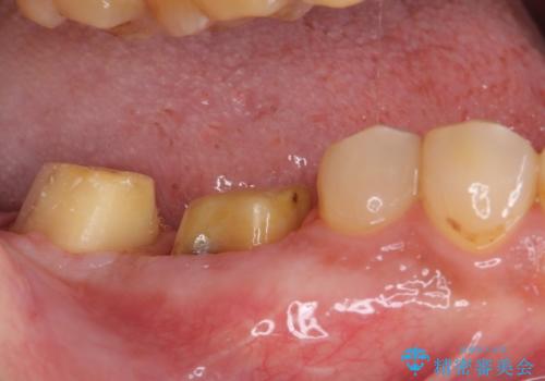 骨の中にまで及んだ深い虫歯 歯周外科処置を用いた補綴治療の治療中