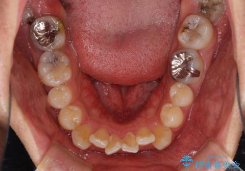 口が少し閉じにくい　インビザラインによる非抜歯矯正の治療前