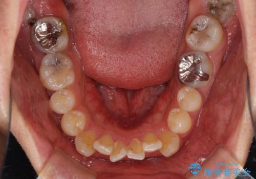 口が少し閉じにくい インビザラインによる非抜歯矯正の治療前