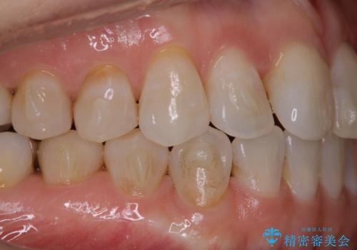 インビザラインで矯正中にクリーニングの治療前