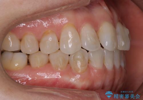 インビザラインで矯正中にクリーニングの治療前
