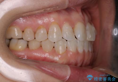 インビザラインで矯正中にクリーニングの治療後