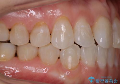 インビザラインで矯正中にクリーニングの治療後