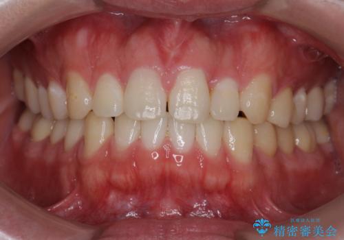 矯正後、オフィスホワイトニングで歯を白くし、さらに口元を爽やかに。の症例 治療前