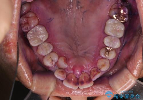 被せ物治療が終了したため全体的にクリーニングをの治療中